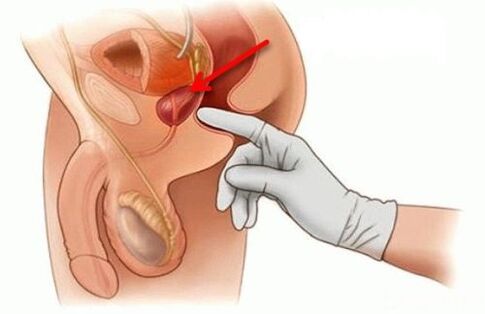Μασάζ προστάτη για προστατίτιδα
